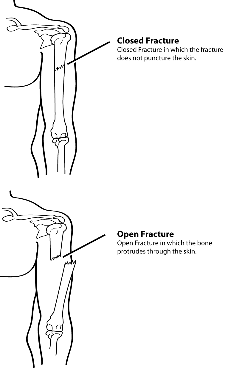 “closed fracture, in which the fracture does not puncture the skin; open fracture, in which the bone protrudes through the skin.”