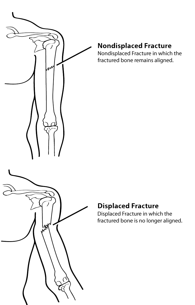 “Nondisplaced fracture, in which the fractured bone remains aligned; displaced fracture, in shich the fractured bone is no longer aligned.”